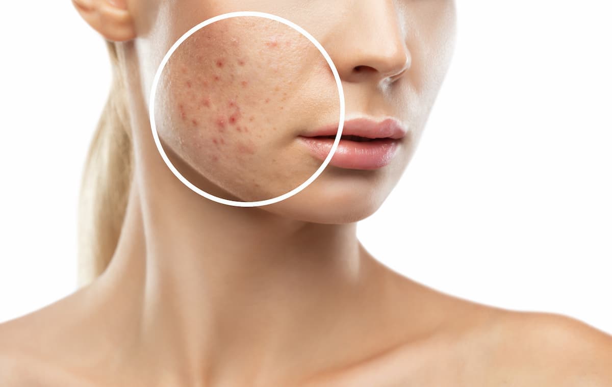 Close-up of facial skin showing acne marks and redness