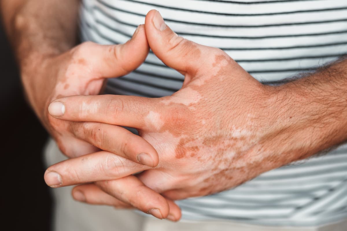 Hands showing skin pigmentation differences associated with vitiligo