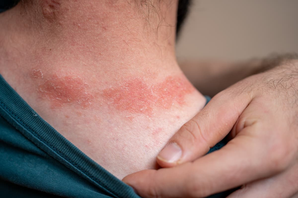 Psoriasis rash