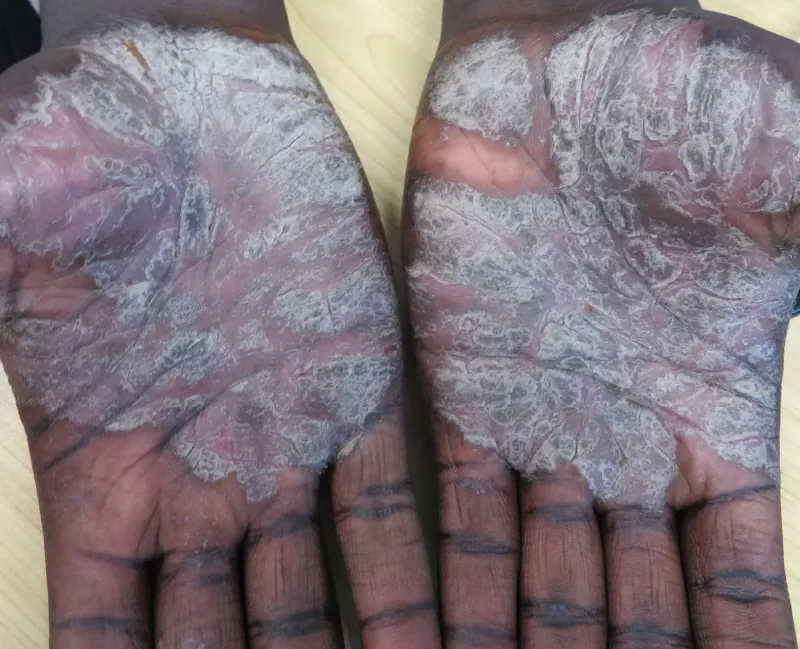 Psoriasis On The Palm Of Hands