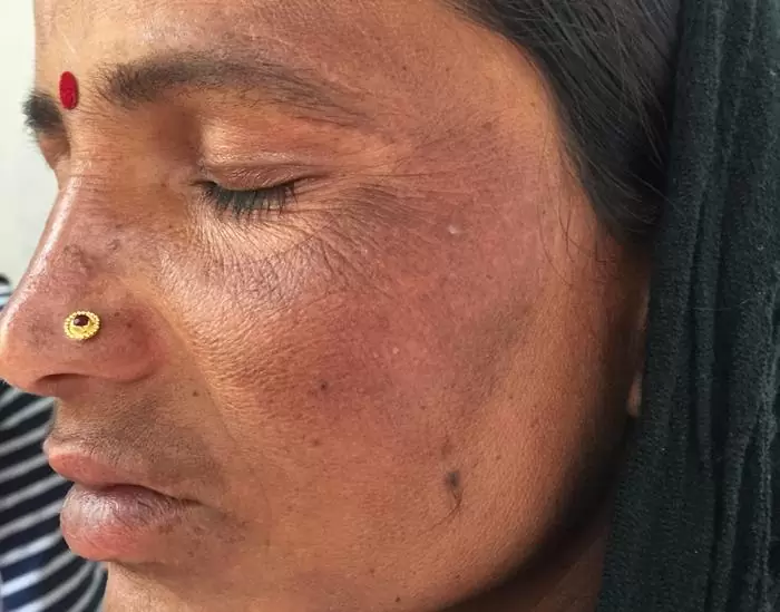 Melasma In An Indian Lady