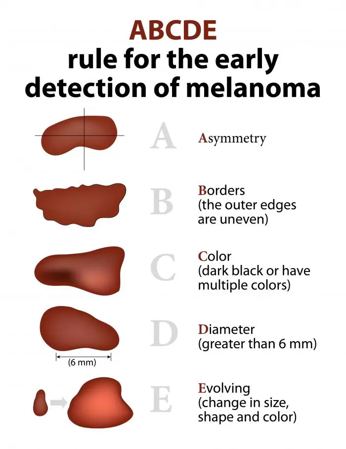 Early Detection Of Melanoma