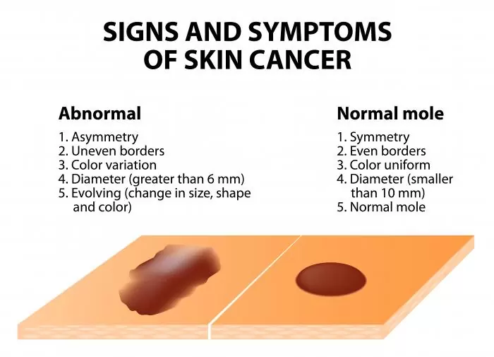 Signs And Symptoms Of Skin Cancer