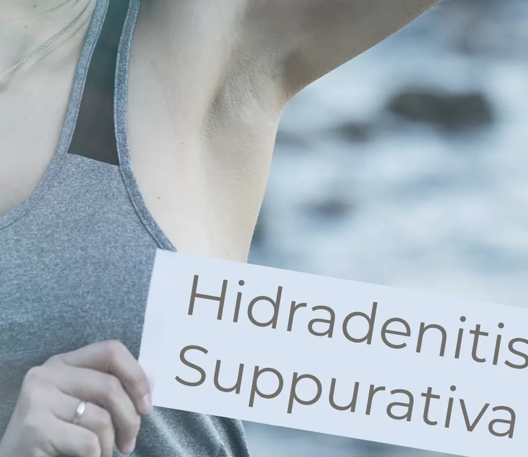 Hidradenitis-Suppurativa-Boils-Chromaderm