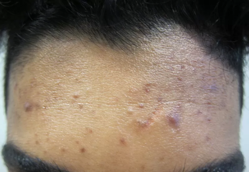 Dermatologist Melbourne Acne